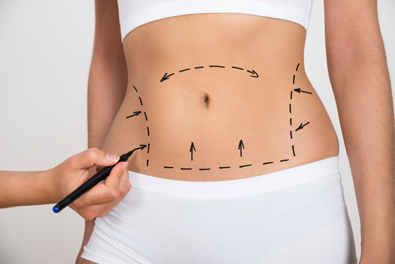 Coolsculpting